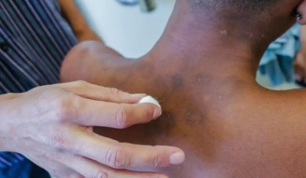 Paciente com hanseníase