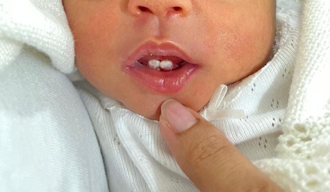Bebê nasce com dentes e passa por extração aos 6 dias no ES